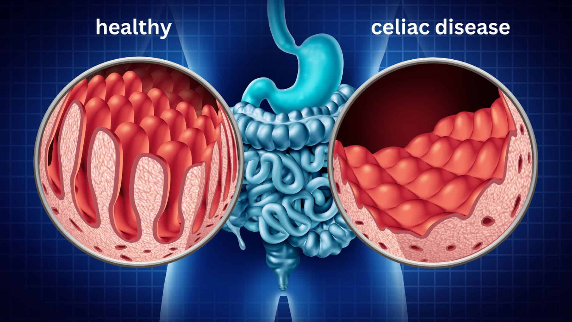 differences in gluten free diets